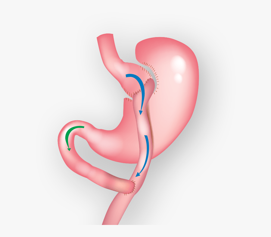 Gastric Bypass