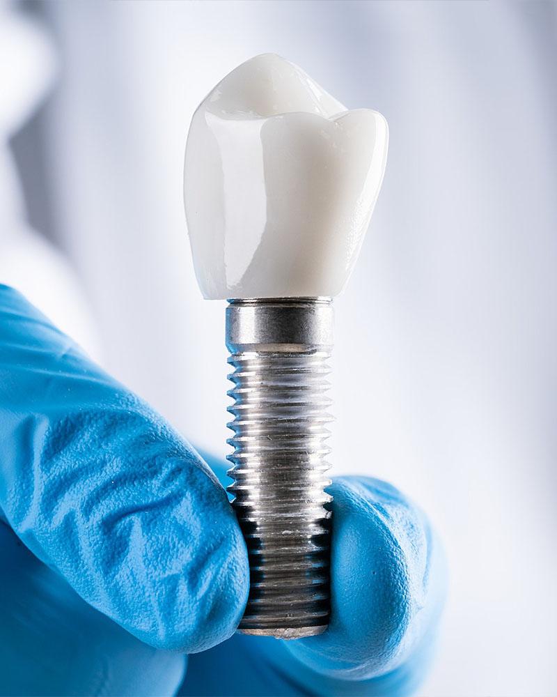 Dental Implant