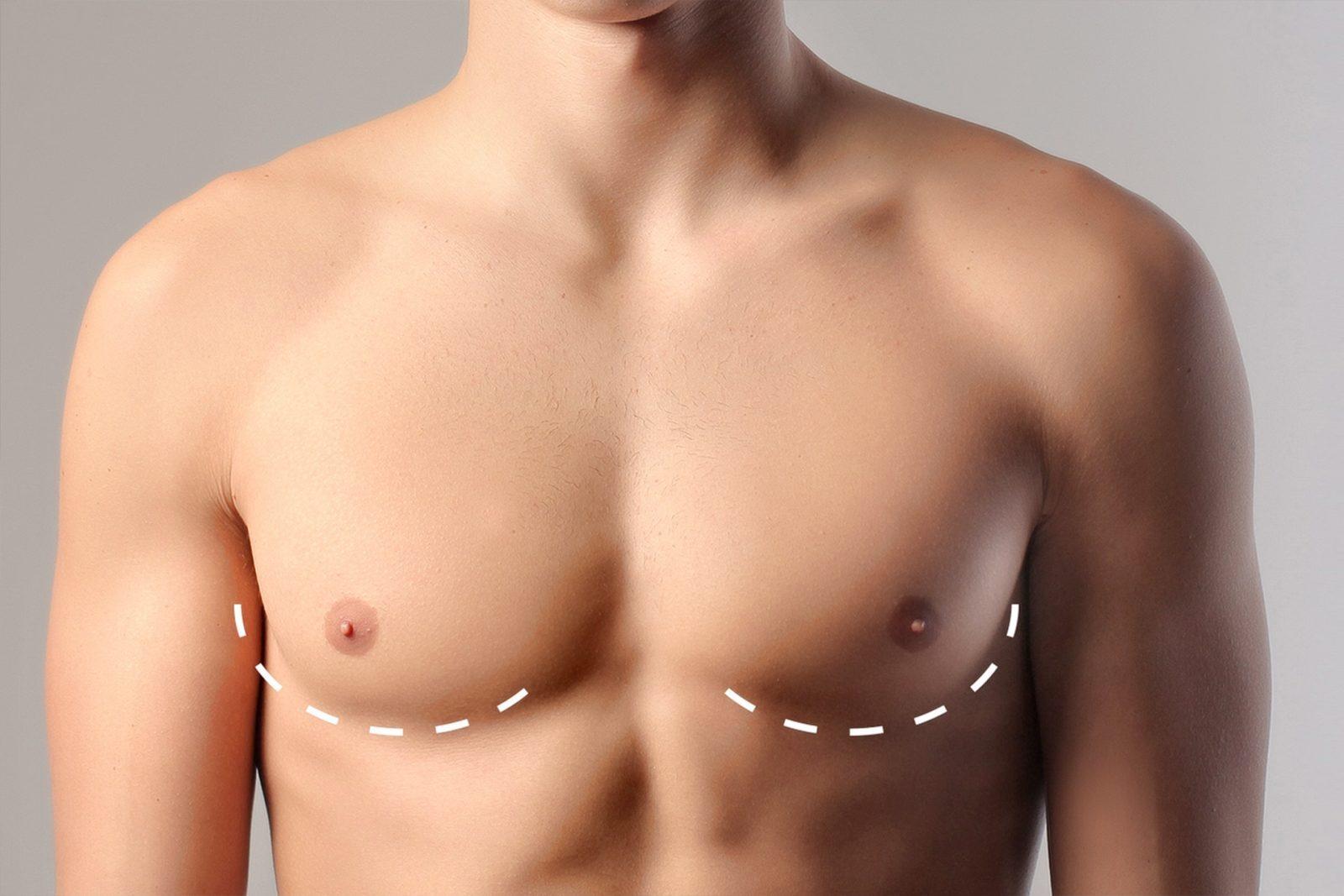 Gynecomastia