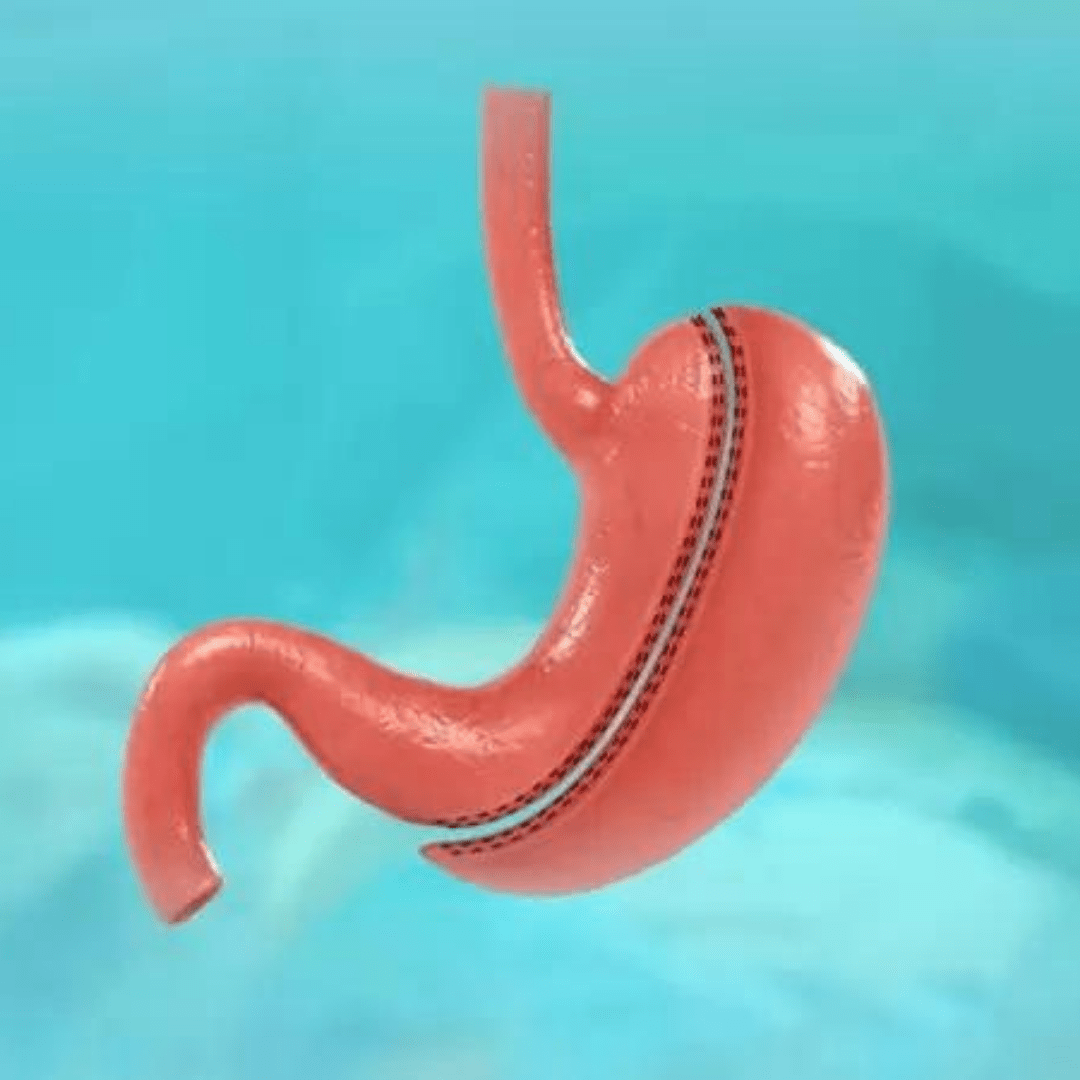 Gastric Sleeves Detail