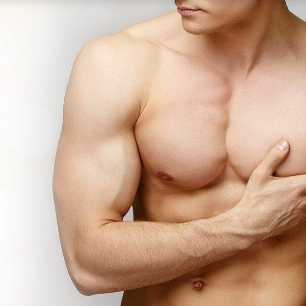 Gynecomastia