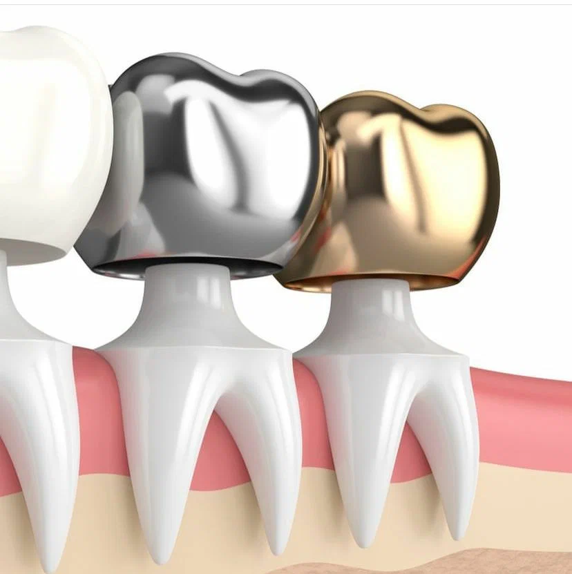 Dental Crown Detail