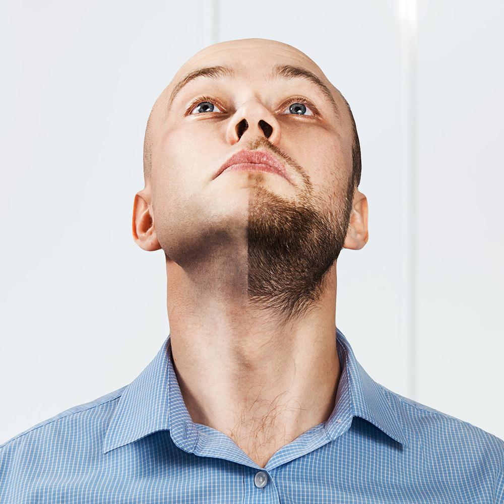 Beard Transplant Detail