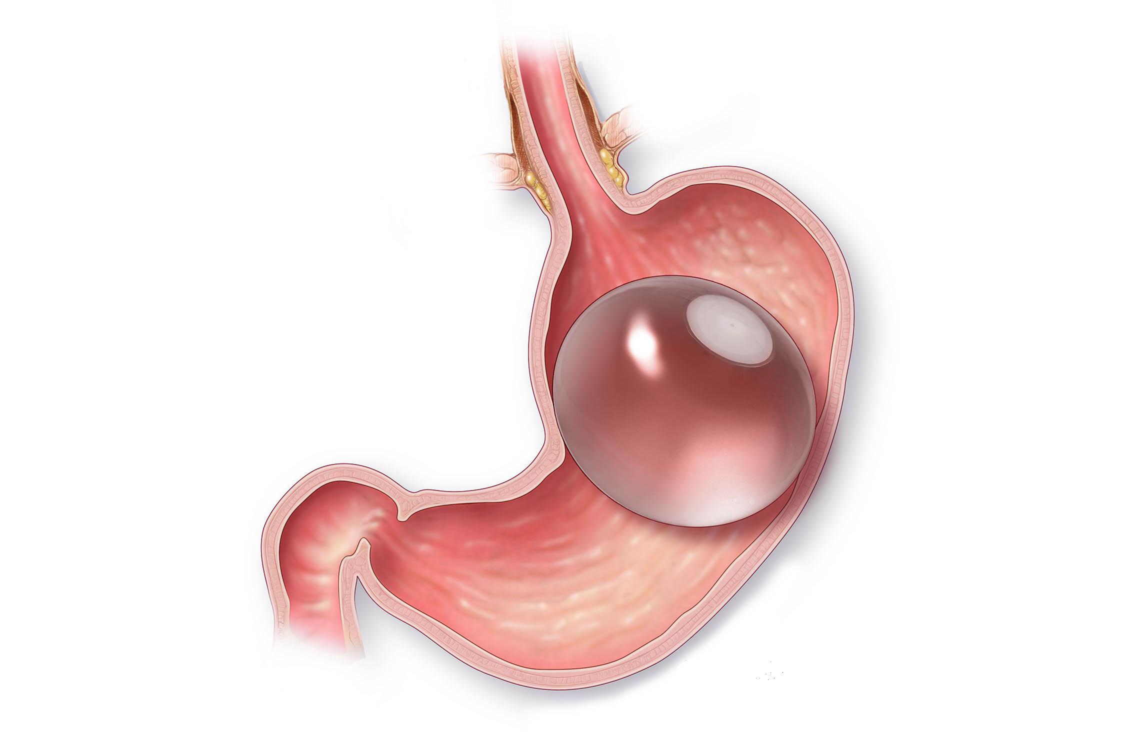 gastric balloon