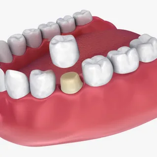 Dental Crown Detail