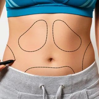 Liposuction