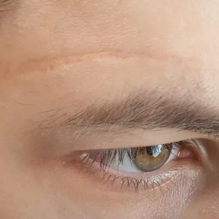 Forehead Scar Revision Detail