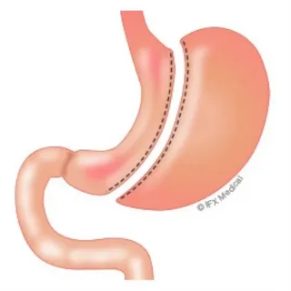 Gastric Sleeves Detail