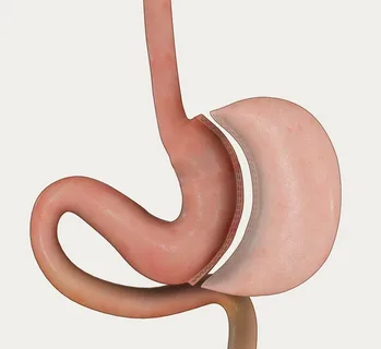 Gastric Sleeves Detail