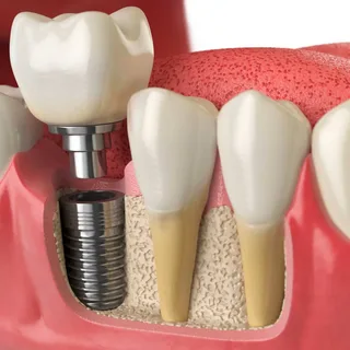 Dental Implant Detail