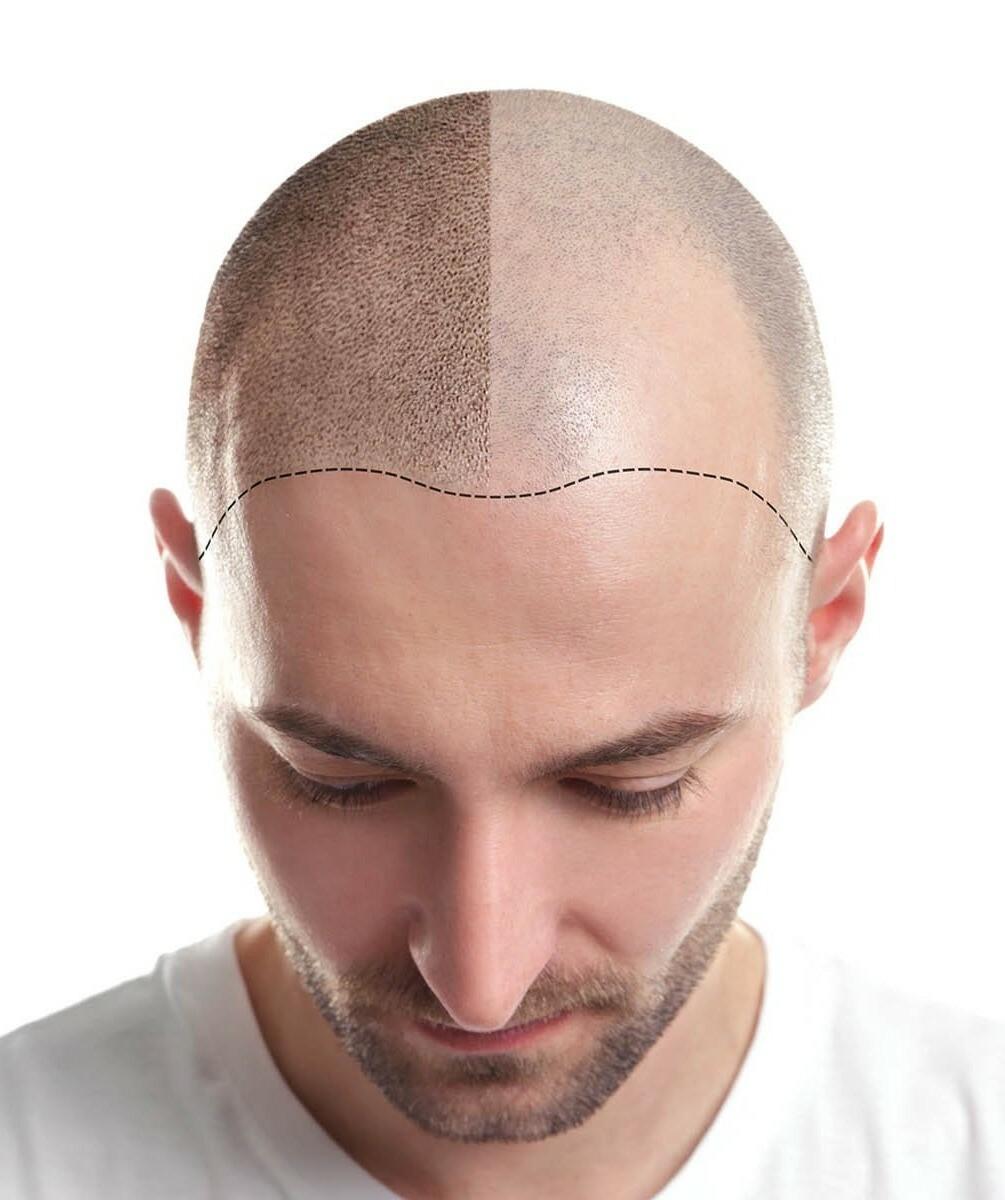 Bald Man Hair Transplant