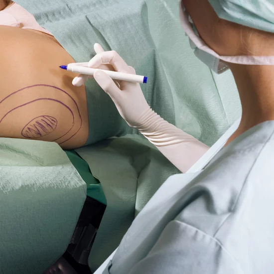 liposuction plastic surgery